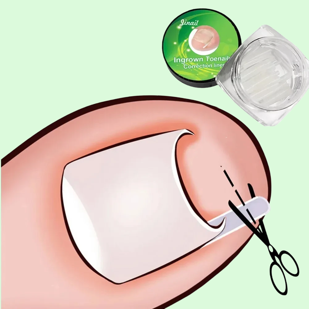 Zavaria ComfortStep Nail Relief Kit