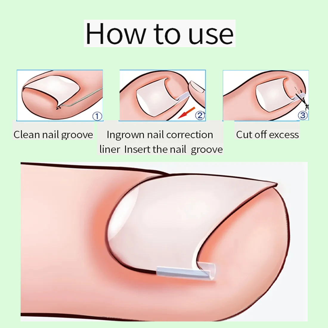 Zavaria ComfortStep Nail Relief Kit