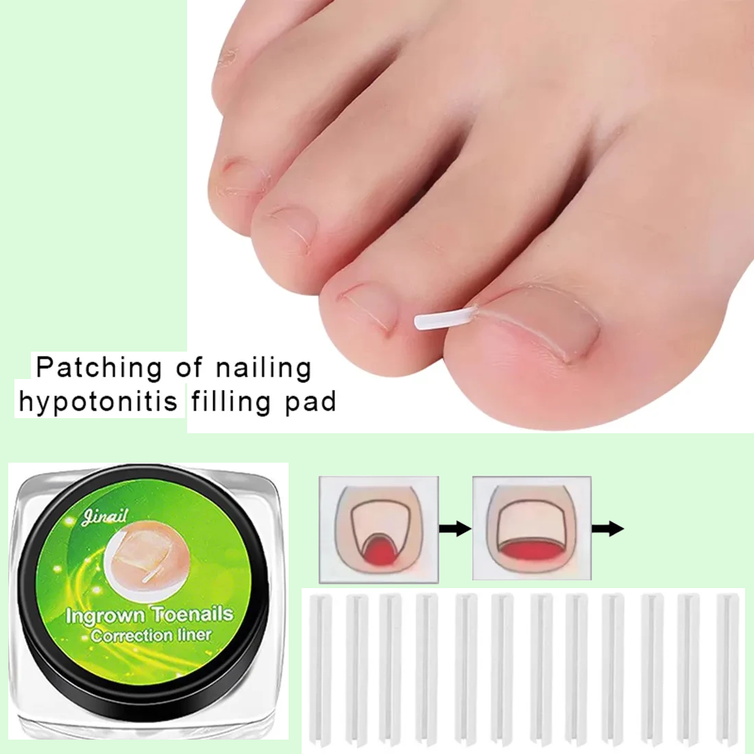 Zavaria ComfortStep Nail Relief Kit